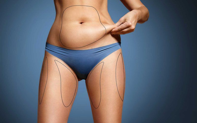 Female body with areas marked for liposuction surgery